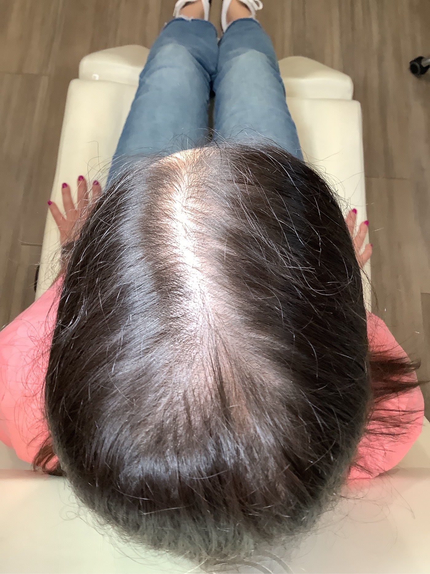 2nd Treatment- May 14, 2025