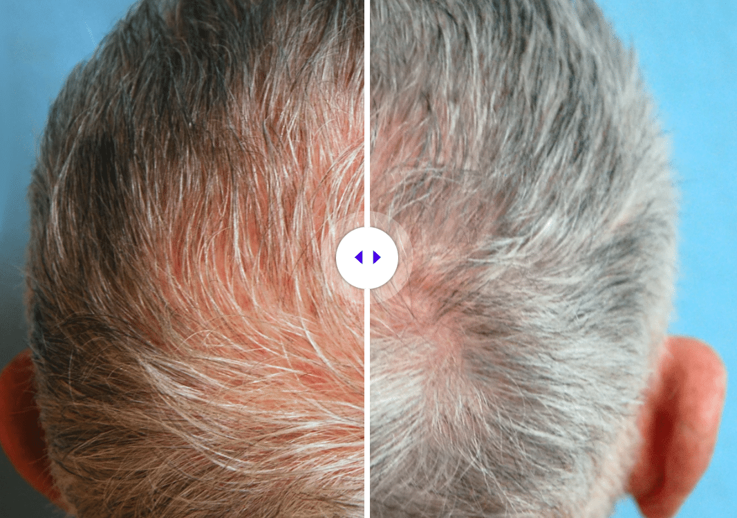 Before and after hair restoration showing visible increase in hair density on scalp