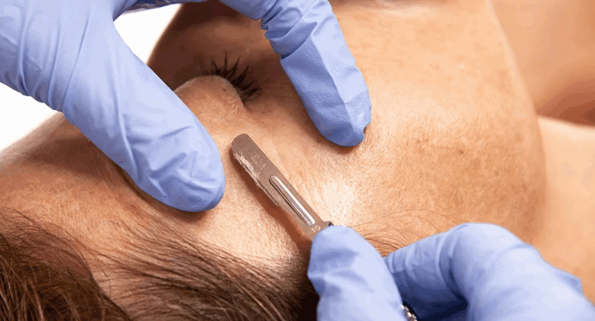 Dermaplane